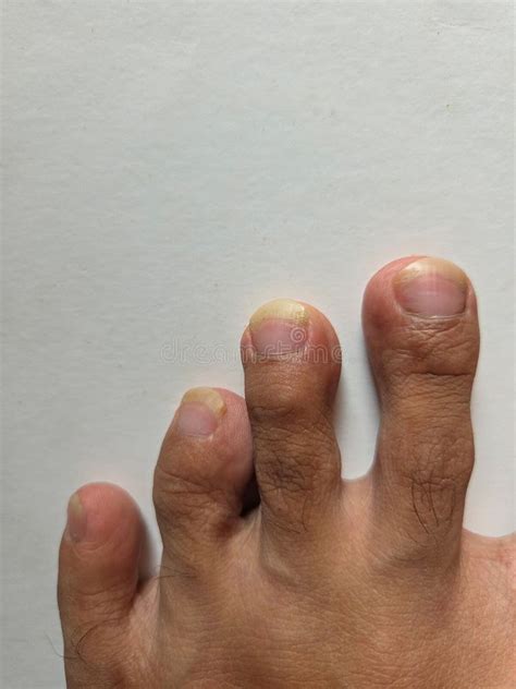 Unusual Toe Alignment Stock Photos - Free & Royalty-Free Stock Photos ...
