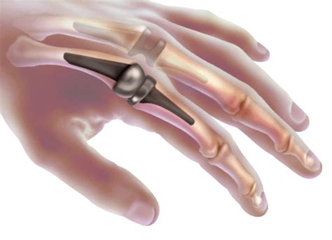 The ArmDoc - Finger joint replacement