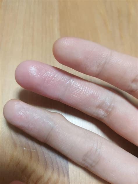 Dominant hand finger skin peeling and not growing back : r