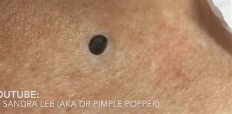 Forget Everything You Know: This is Unbelievable Blackhead Removal 2024 - 4191zpg