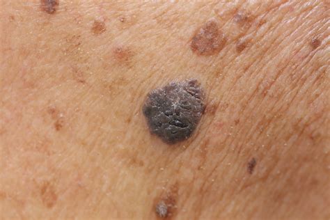 seborrheic keratosis