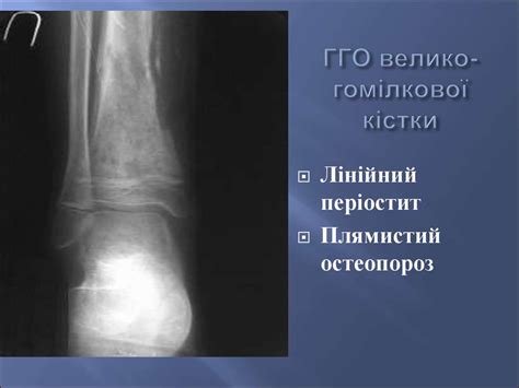 Особливості гнійної інфекції у новонароджених. Флегмона. Мастит ...