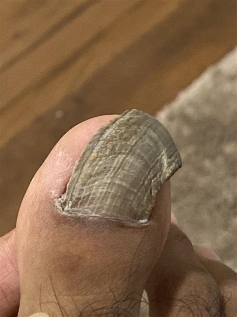 Ingrown toenail advice. : r/Ingrown_Toenails