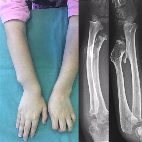 O Que É Deformidade - Deformidade no Punho causada por Osteocondromatose Múltipla Congênita ...