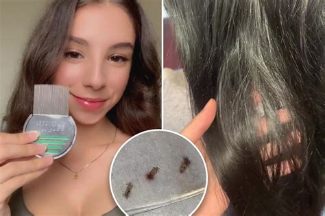 Human Lice Eggs