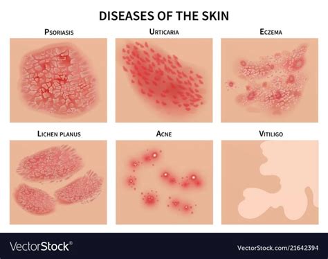 Treatment of Skin Diseases, Complication, Prevention - Rxharun