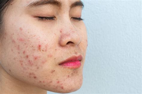 acne breakouts  comprehensive guide   tr skin