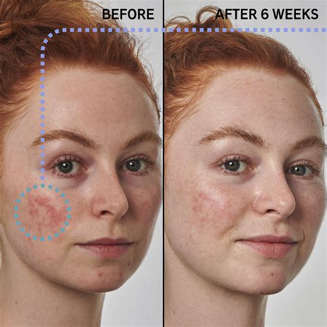 Azelaic Acid Acne