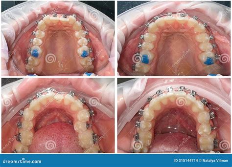 braces  installed upper   jaw stock photo