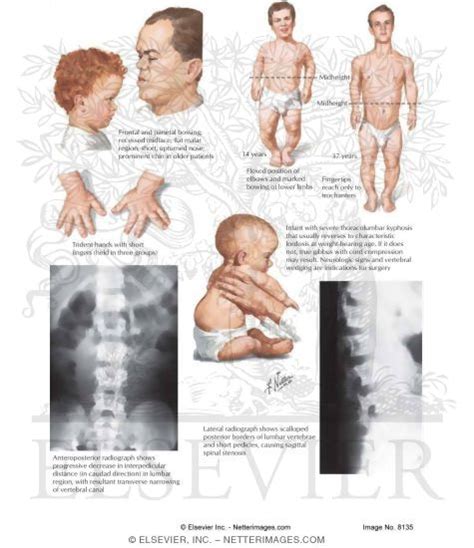 Achondroplasia