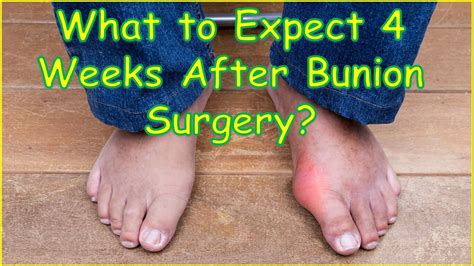 expect  weeks  bunion surgery