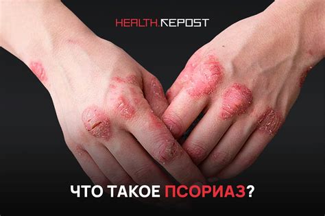 «Мое настроение напрямую влияет на развитие болезни»: что такое псориаз