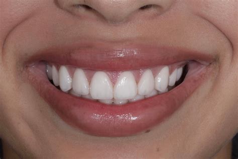 YELLOW TEETH TO PORCELAIN VENEERS - Sonrisa Italiana