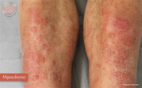 hypothyroidism skin