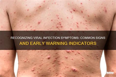 recognizing viral infection symptoms common signs  early warning