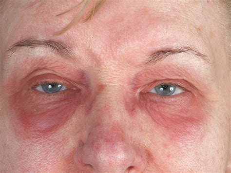 Periorbital Edema In Dermatomyositis Medizzy - vrogue.co