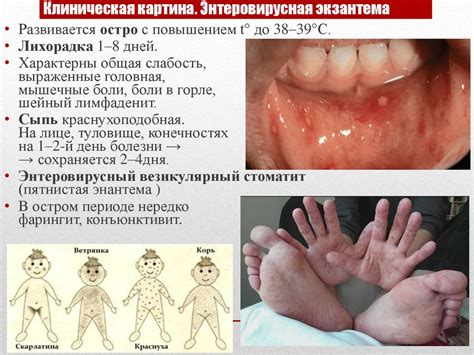 Энтеровирусные инфекции (вирусы Коксаки и ECHO) - презентация онлайн