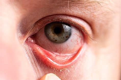Dry Eyelids: Possible Causes, Care & Treatments