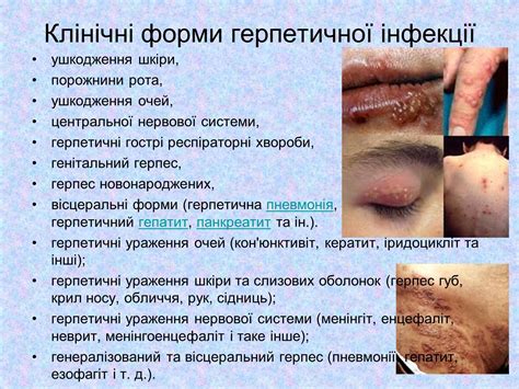 Презентація на тему Вірус Герпесу — презентації з біології | GDZ4YOU