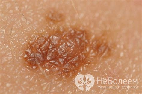 Невус: что это такое, фото, виды, как лечить, причины появления