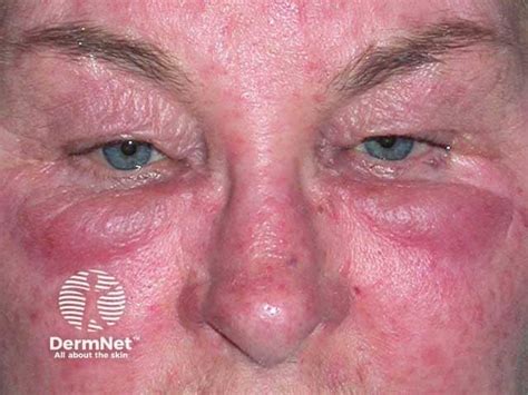 erythematous puffy face