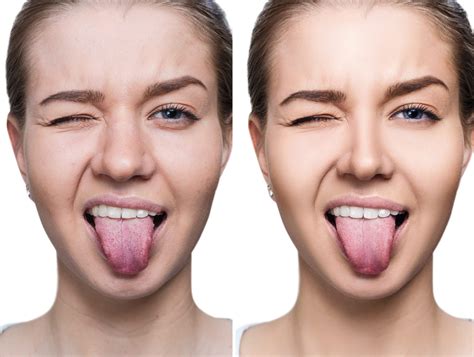 Everything You Need to Know About White Spots on the Tongue - Patient