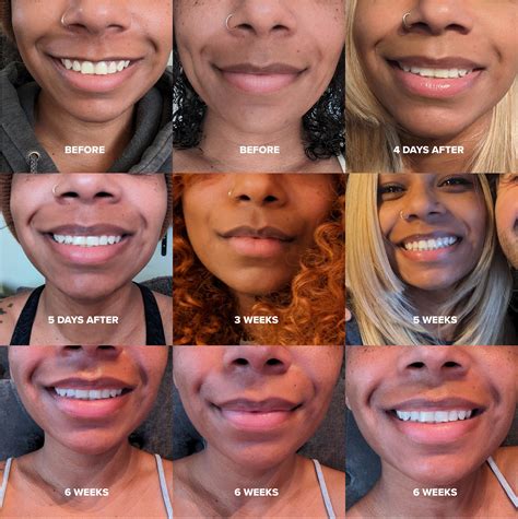 lip flip   afters rplasticsurgery