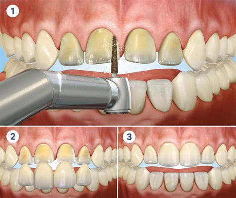 Porcelain Dental Veneers In Rockville Centre - Professional Community ...