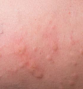 skin diseases list with pictures - Anjelica Certalich