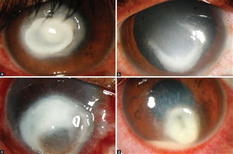 Indian Journal of Ophthalmology