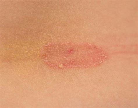 penyebab kurap alodokter