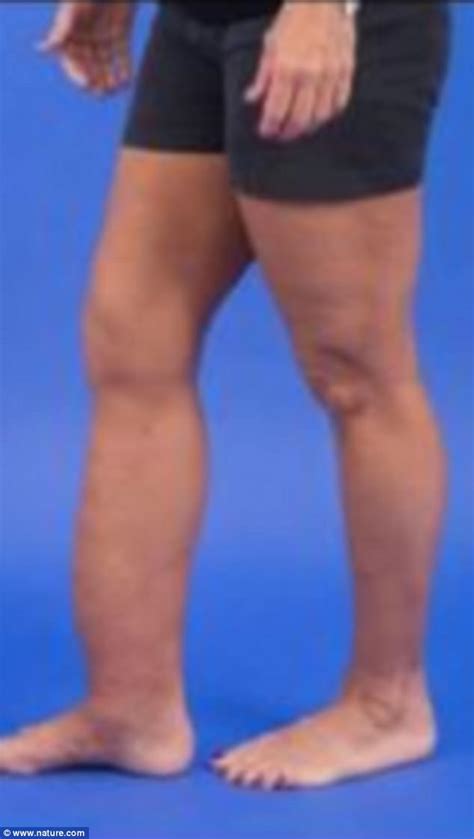 Mystery behind ‘dripping candle wax’ disease is cracked | Daily Mail Online