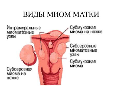 Миома матки - online presentation