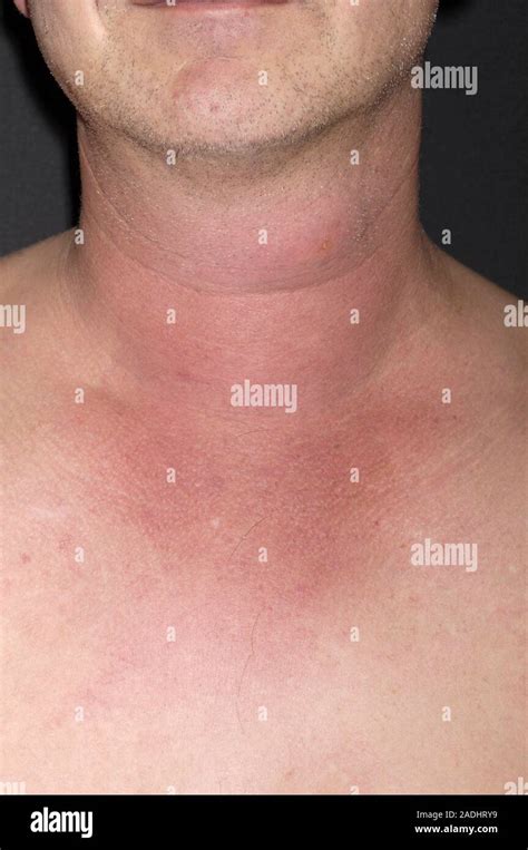 Insect bite allergy. Allergic reaction to an insect bite on the neck of ...
