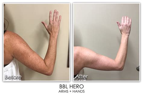 bbl hero bbl archives skin rejuvenation clinic skin rejuvenation clinic