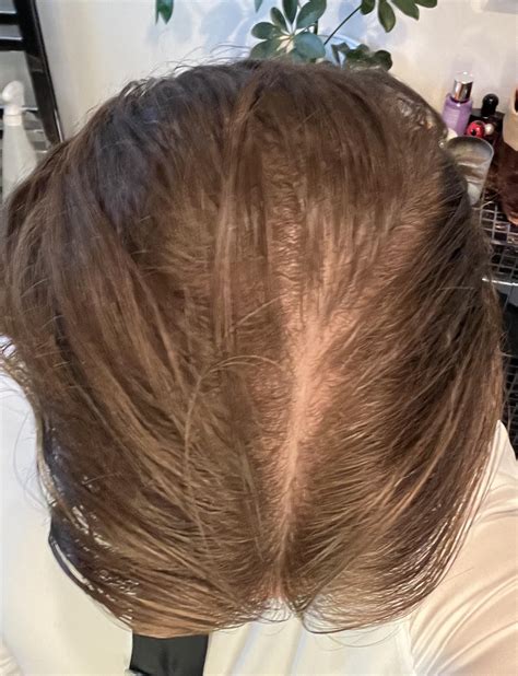 Bad? Balding? 20yrs old : r/Hairloss