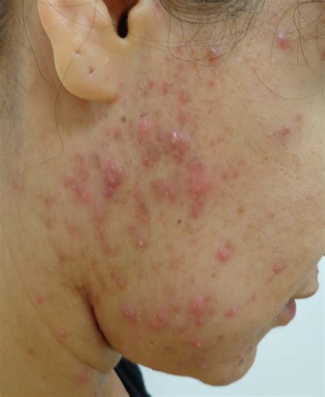 ACD A-Z of Skin - Adult Acne