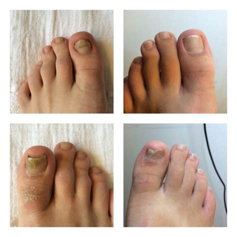 Schimmelnagel behandelen met chloor ? Lees hier hoe