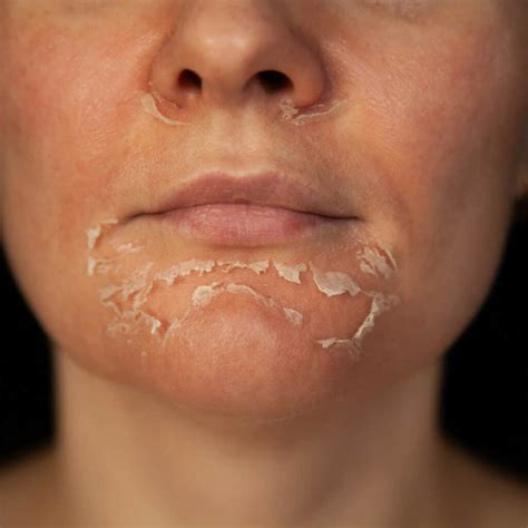 peeling skin      vie aesthetics