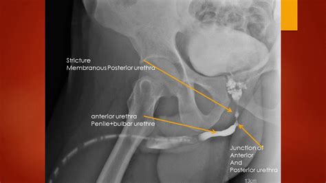CASE 505 ascending retrograge urethrography stricture posterior ...