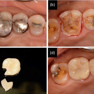 (PDF) Partially Coverage Restoration: An Esthetically Conservative Treatment for a Complex ...