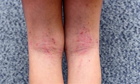 symptoms treatment  dermatitis  inflammation   skin