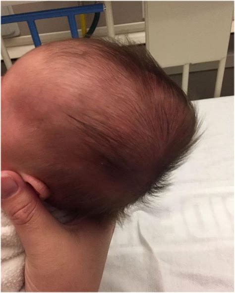 caput succedaneum comprehensive explanations   paramount