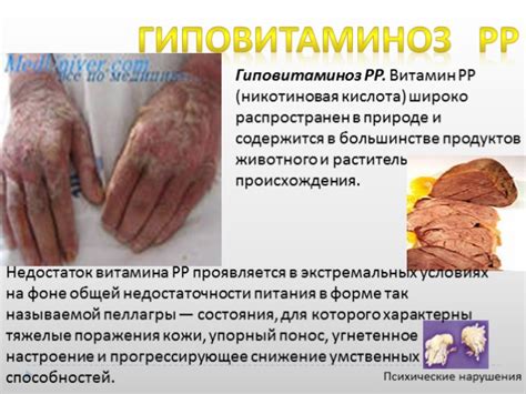Презентация - Гиповитаминозы
