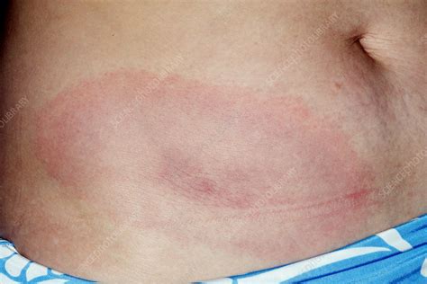 Lyme Rash Erythema Migrans