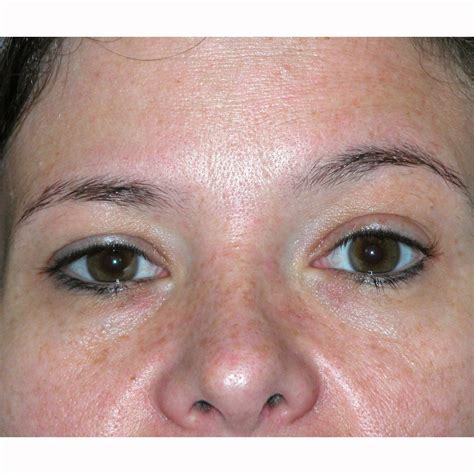 Before & After Blepharoplasty 13 Photos | J. Brian Boyd, M.D.