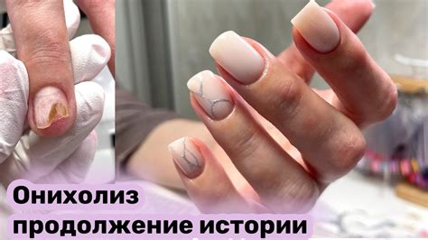 ОНИХОЛИЗИС НА НОГТЯХ / ГЕЛЬ-ЛАК: ПОЛЬЗА ИЛИ ВРЕД? - YouTube