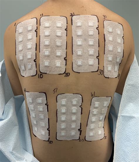 Types Of Patch Testing at Jayden Nobbs blog