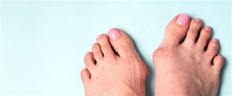 Bunion treatment, how to get rid of it | COMPEED®