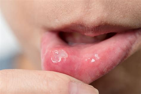 Canker Sore Treatment & Causes | Greenwoods Dental Blog